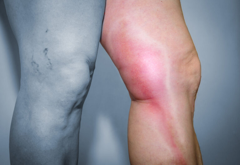 The Importance of Early Detection and Treatment in Superficial Vein Phlebitis￼