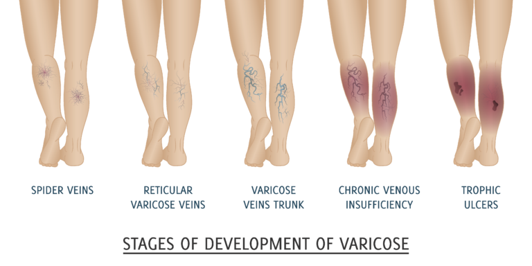 The 5 Stages of Varicose Veins: Are You at Risk for Serious Complications?